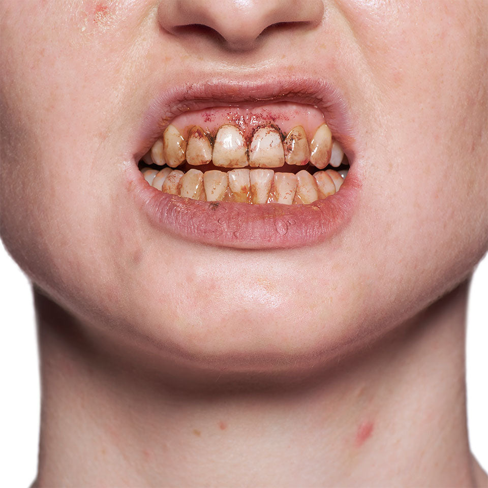 Tooth Enamel